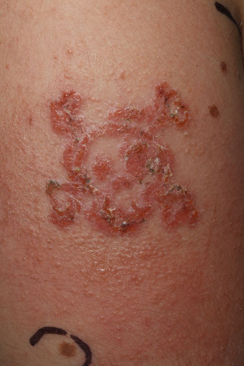 Black Henna Tattoo Allergic Reaction
