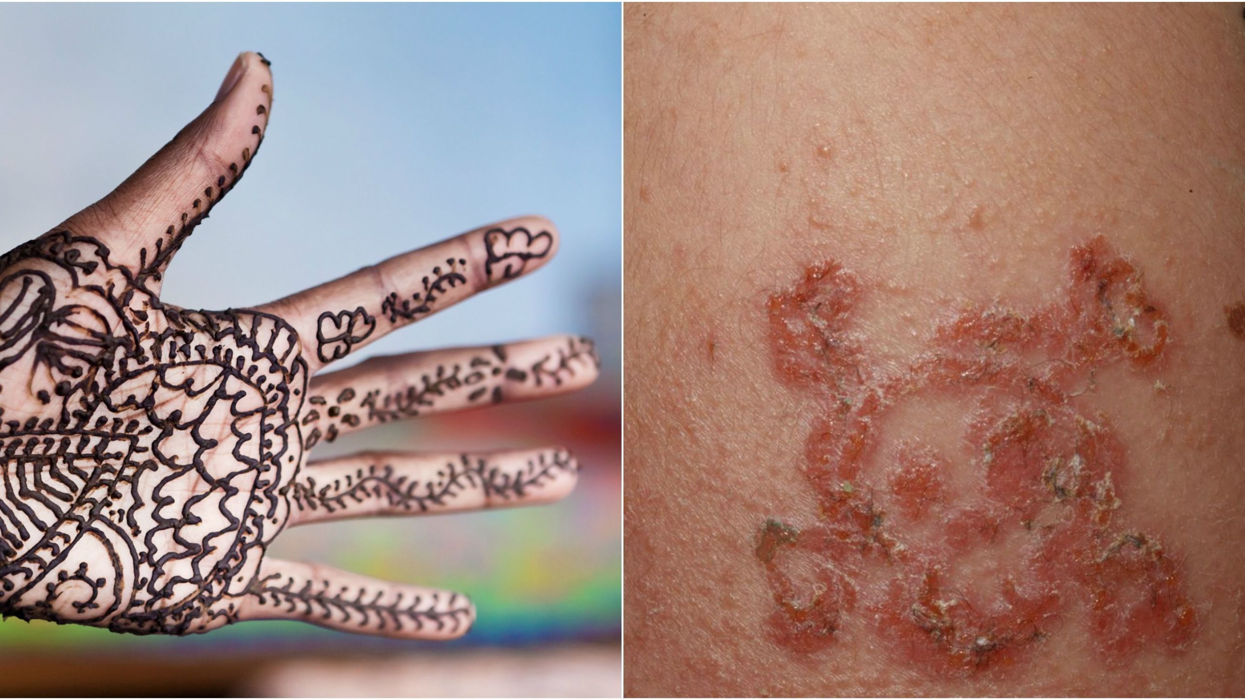 Black Henna Tattoos Can Cause Severe Skin Reactions, Case Shows | Live  Science