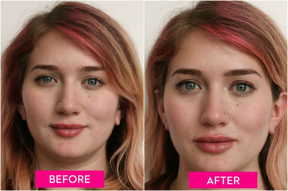Lip Injections - Before And After Lip Fillers