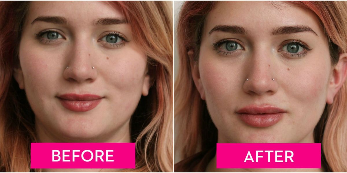 Lip Injections - Before And After Lip Fillers