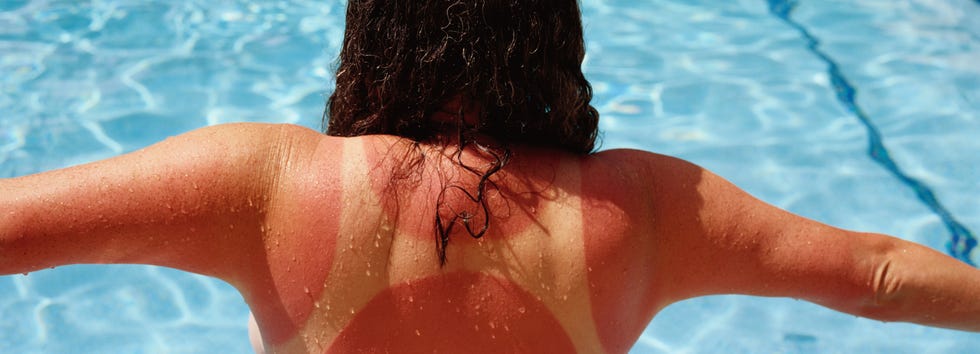 sunburn back