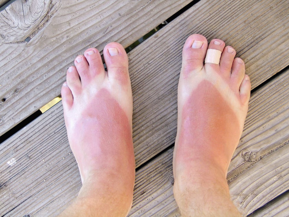 sunburn feet