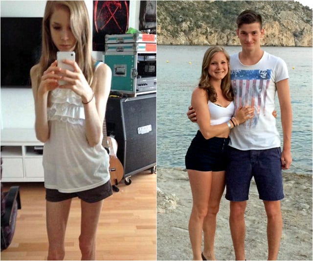 Teen Credits Falling in Love Remarkable Recovery From Anorexia