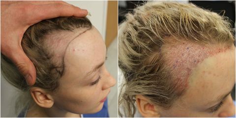 Diva Hollands Follicular Unit Transplantation - Traction Alopecia