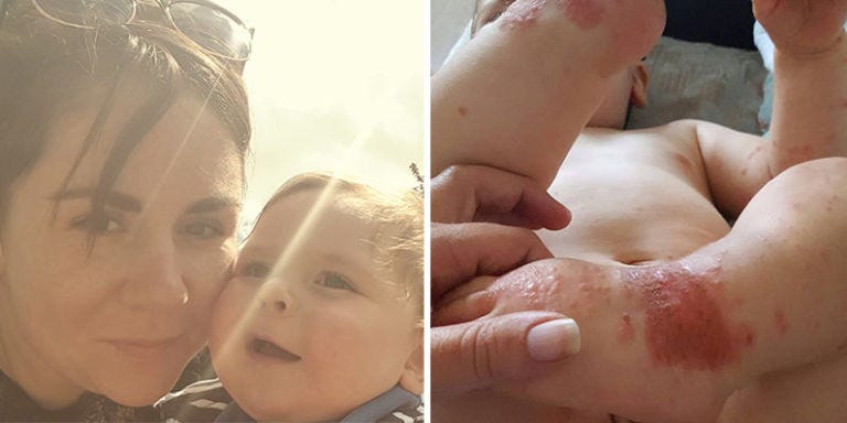 Don't Kiss Your Kids When You're Sick, Mom Warns - Baby Gets Herpes After Contact With Cold Sore Don't Kiss Your Kids When You're Sick, Mom Warns - Baby Gets Herpes After Contact With Cold Sore