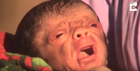 Baby Born With The Face And Body Of An Old Man Progeria Disease