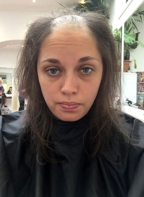 Bride With Trichotillomania Gets Dream Hair For Her Wedding