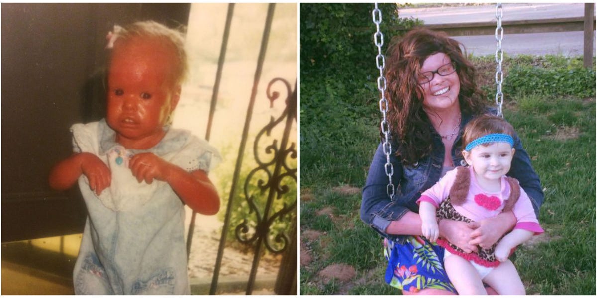 I M The First Mom With Harlequin Ichthyosis Stephanie Turner Essay I M The First Mom With Harlequin Ichthyosis Stephanie Turner Essay