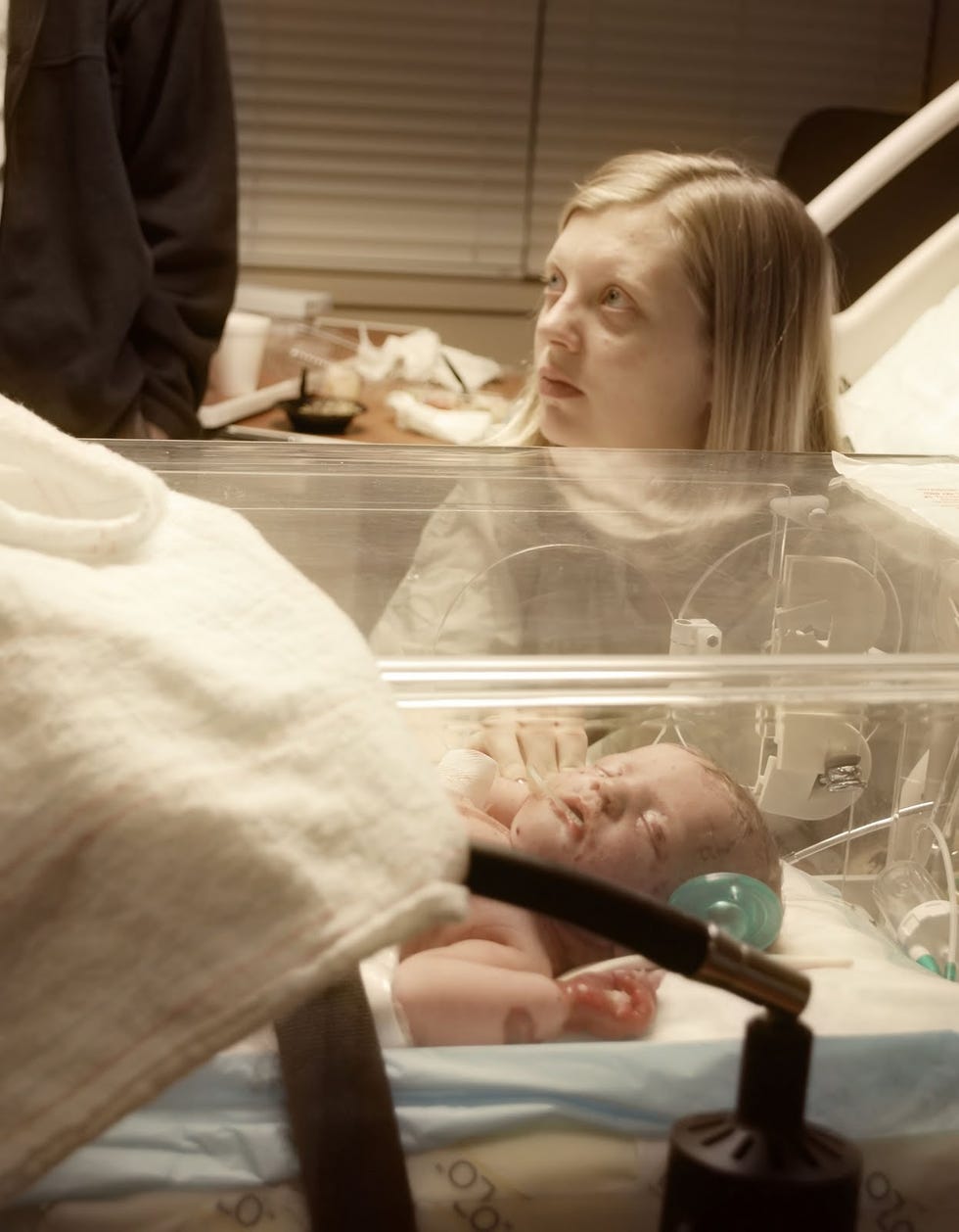 Epidermolysis Bullosa