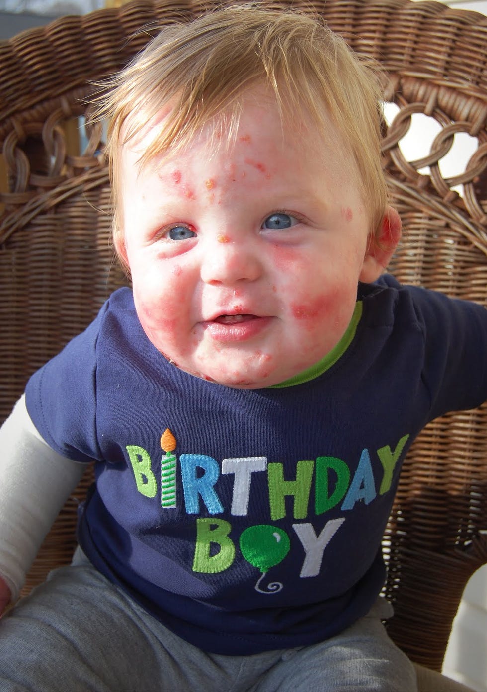 Epidermolysis Bullosa