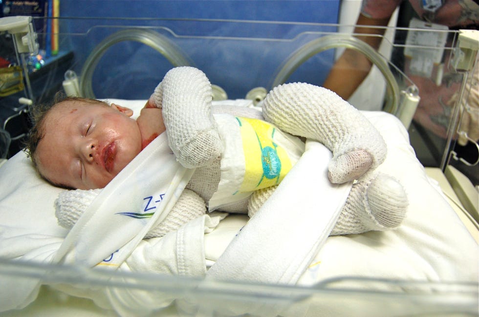epidermoylsis bullosa