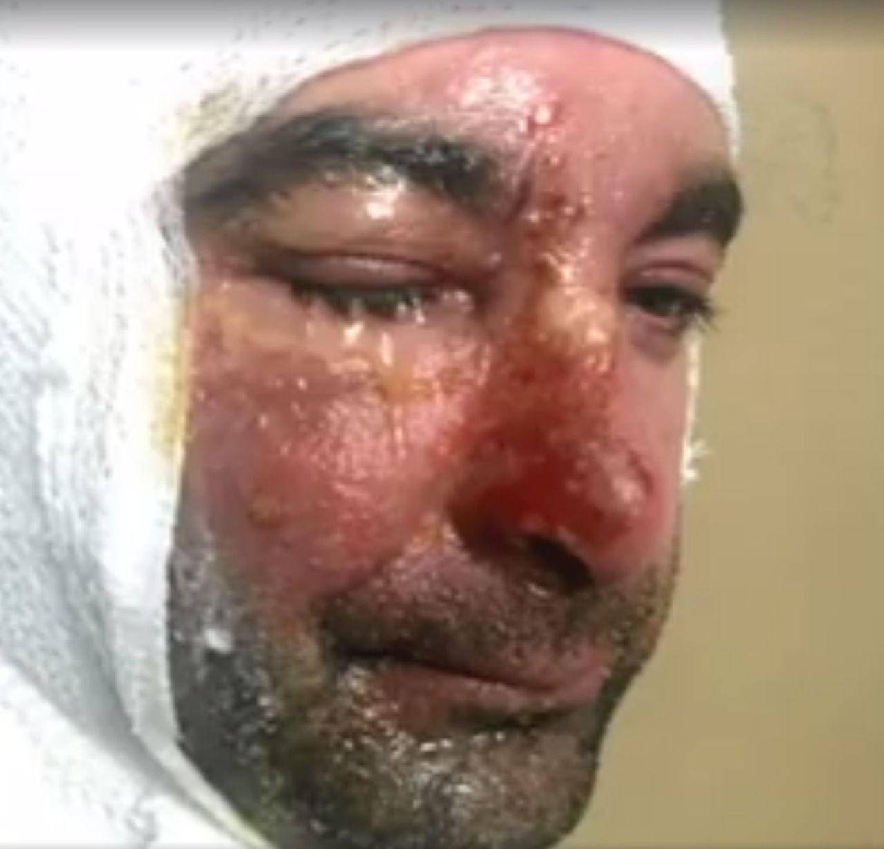 nutribullet injury
