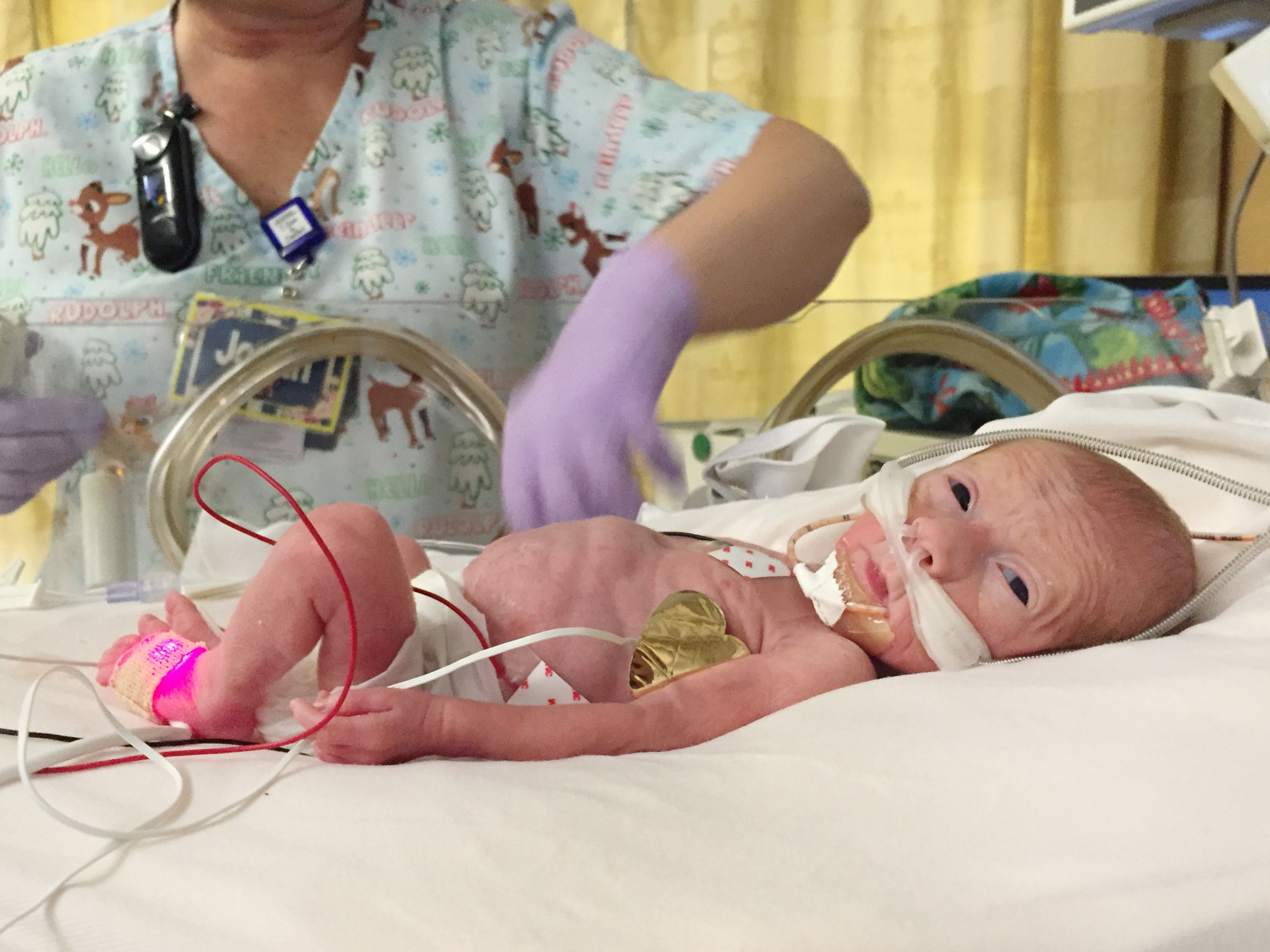 six month premature baby