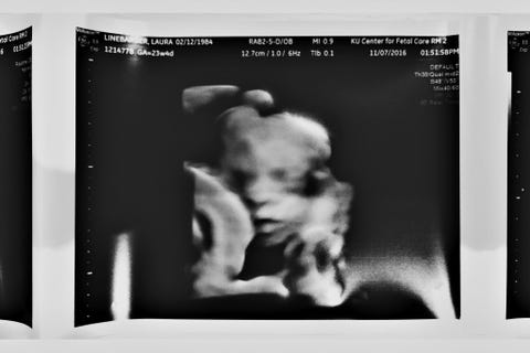 sonogram Whitney Linebarger premature daughter baby