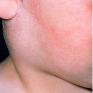mumps rash