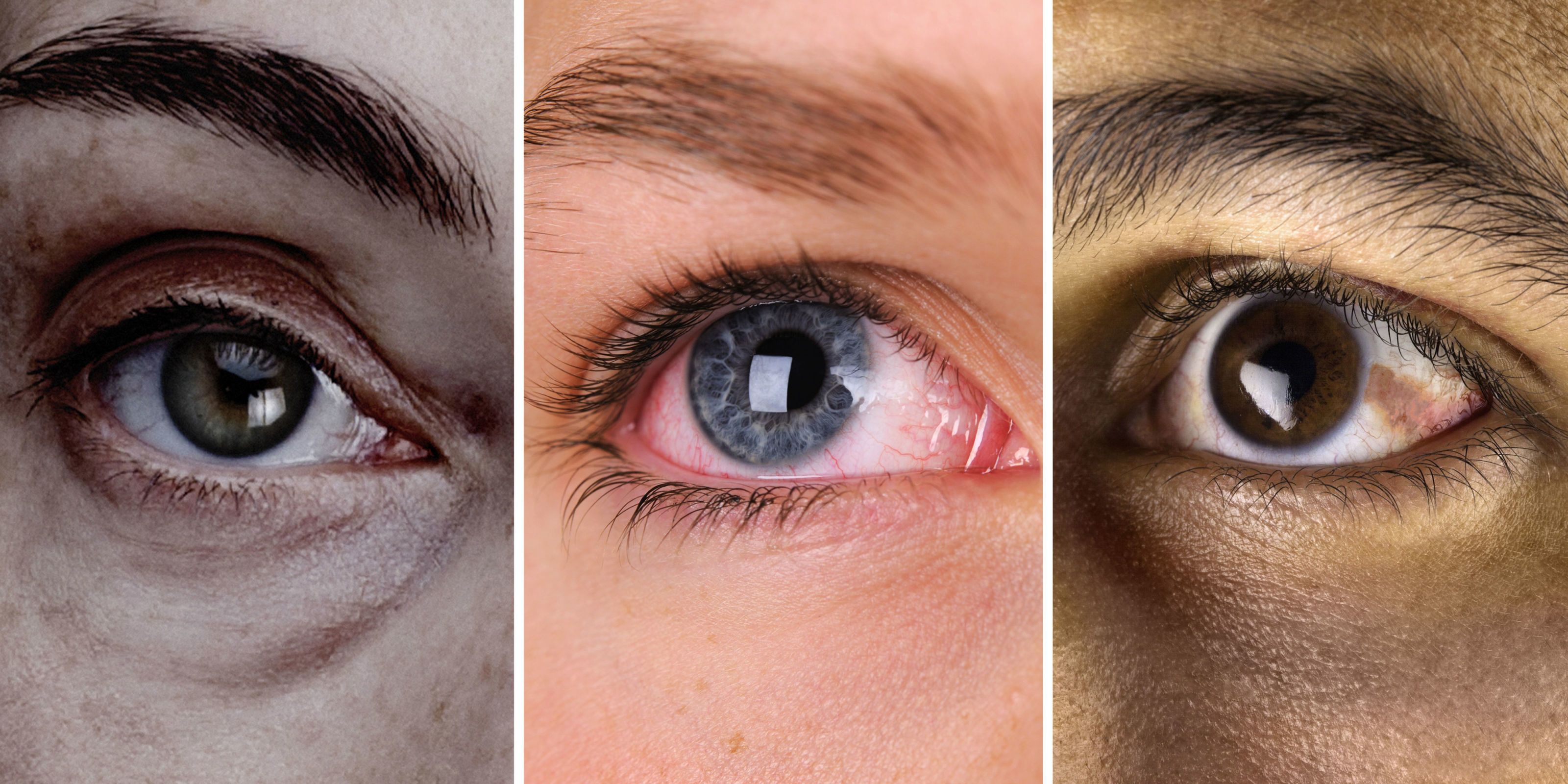 White Spot on Eye: Causes, Treatment & More - Man Matters