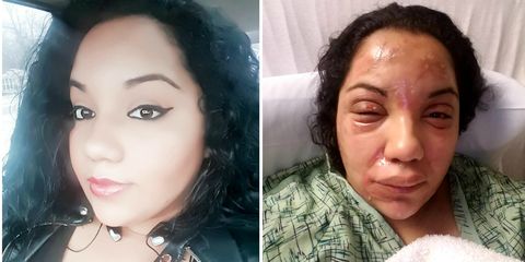 nutribullet explodes leaving woman with second degree burns
