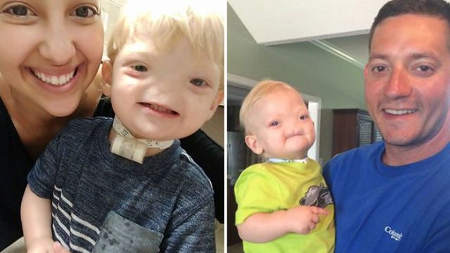 Eli Thompson, Boy Born Without a Nose, Dies at Two Years Old - Congenital Arhinia