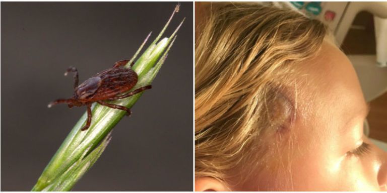 7-Year-Old's Tick Bite Stumped Doctors - Unusual Bullseye Rash Hid Lyme