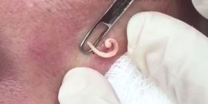 Watch Dr Pimple Popper Remove So Many Milia From This Patient S