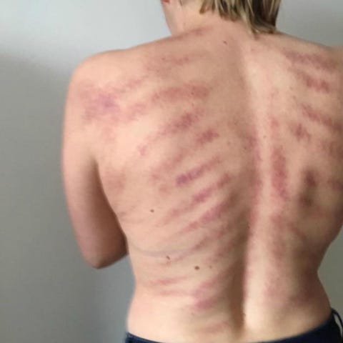 These Graphic Photos Show How Painful Being A Hairstylist Can Be