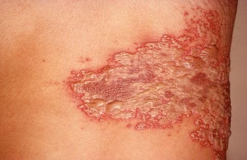 shingles herpes zoster rash