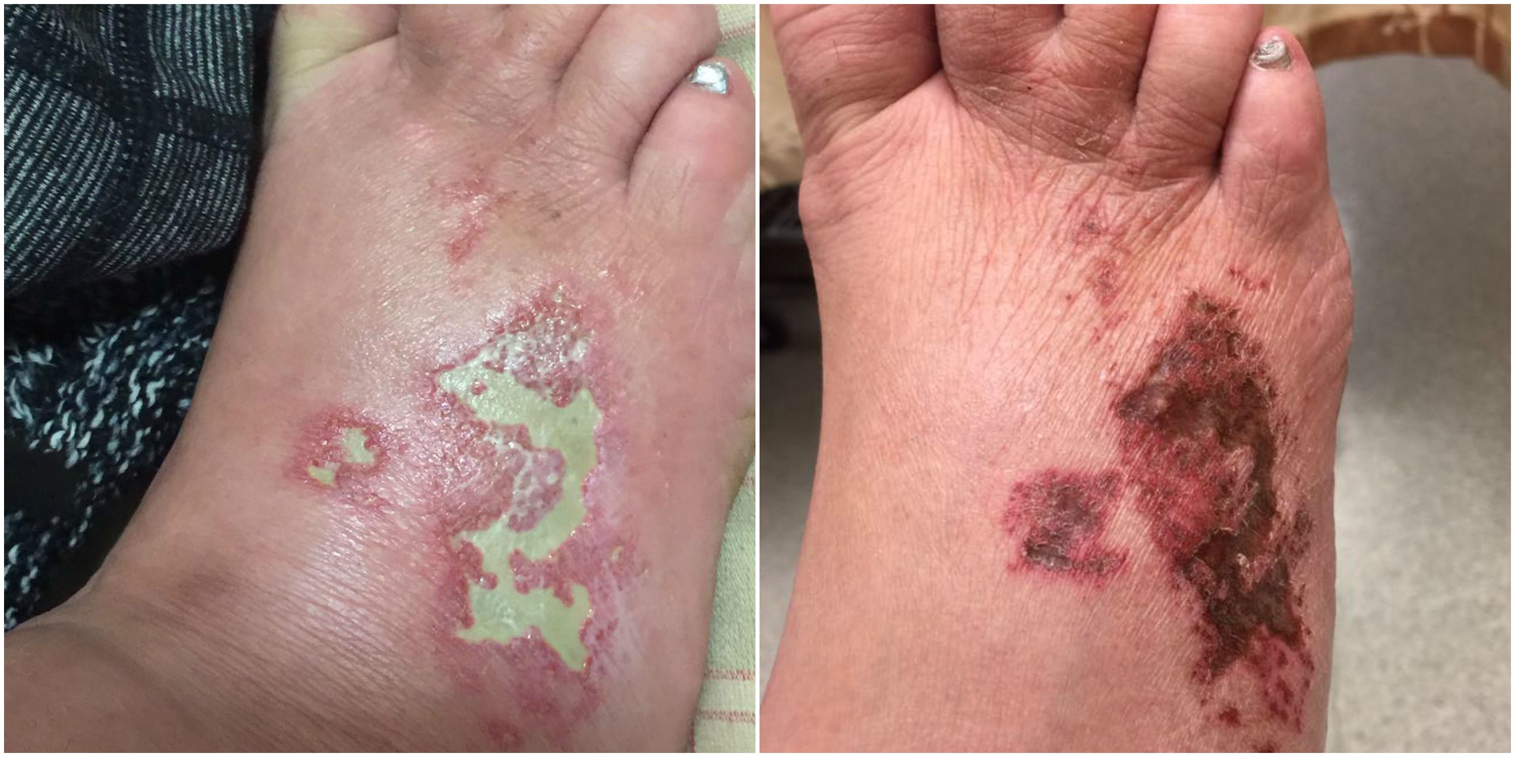 Woman Says She Suffered Horrifying Burns On Her Foot During Salon