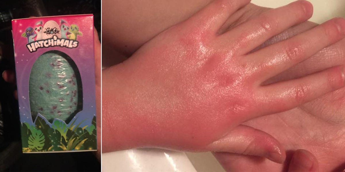 Mom Says Her Daughter Suffered Chemical Burns From A Hatchimals Bath Mom Says Her Daughter Suffered Chemical Burns From A Hatchimals Bath