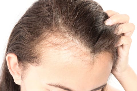 alopecia