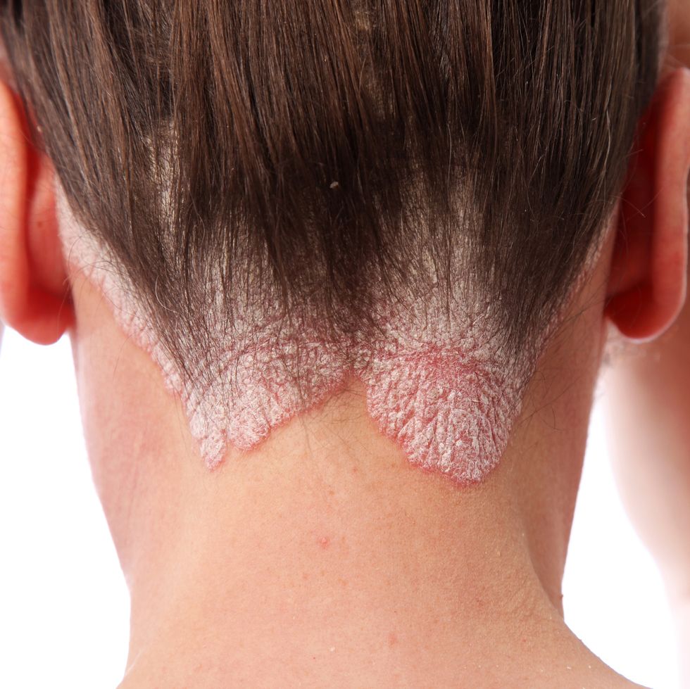 Common Scalp Issues: Pictures, Causes and Treatments