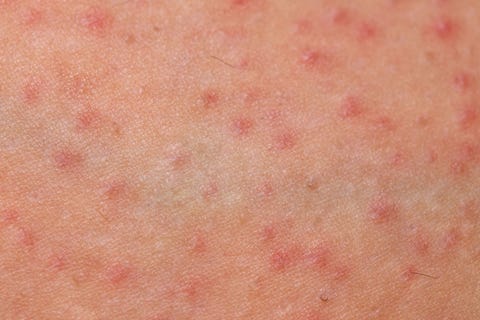 folliculitis