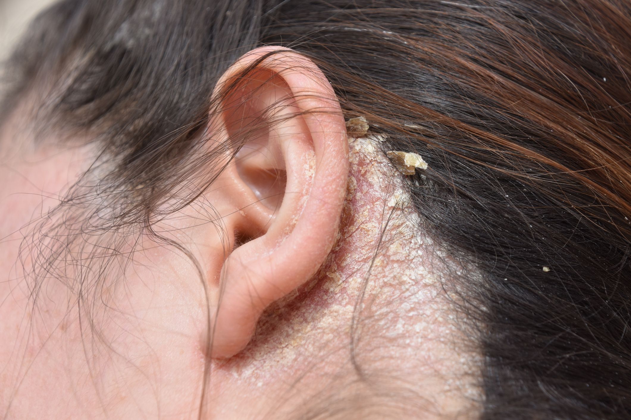 Scalp Acne Types Causes Treatments  Prevention  Vedix