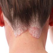 how-to-treat-common-scalp-issues