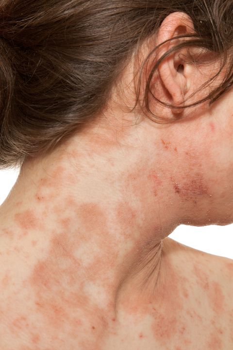 The 6 Most Common Types Of Eczema And How To Treat Them Kinds Of Eczema And Dermatitis