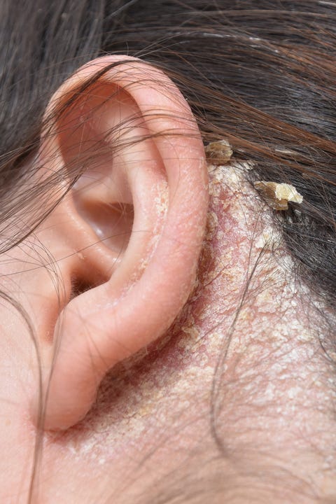 The 6 Most Common Types Of Eczema And How To Treat Them Kinds Of Eczema And Dermatitis The 6 Most Common Types Of Eczema And How To Treat Them Kinds Of Eczema And Dermatitis