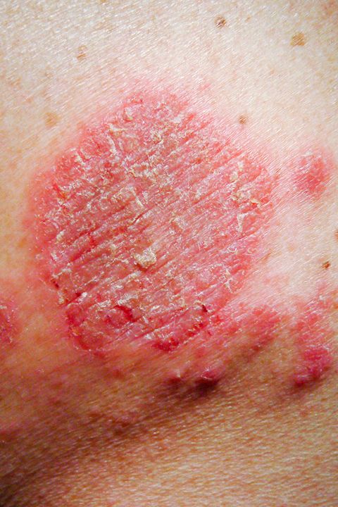 The 6 Most Common Types Of Eczema And How To Treat Them Kinds Of Eczema And Dermatitis