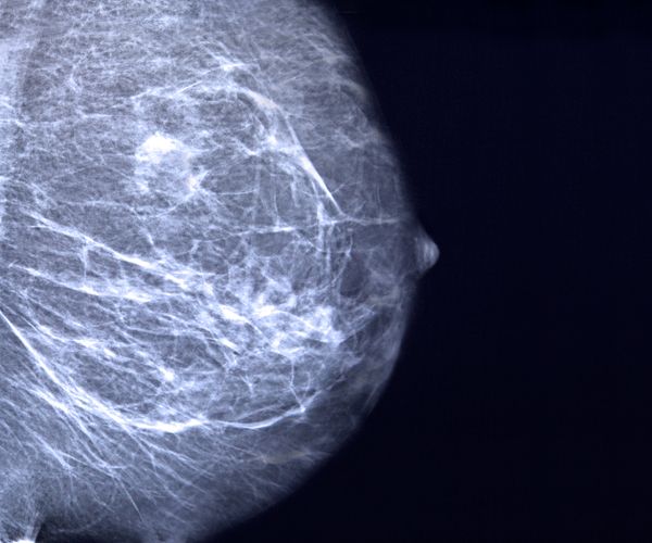 What Does Breast Cancer Look Like On Mammogram Images / Focal Asymmetric Densities Seen At Mammography Us And Pathologic Correlation Radiographics : A screening mammogram is performed at regular intervals to check for breast cancer in women who have no signs or symptoms of the disease.