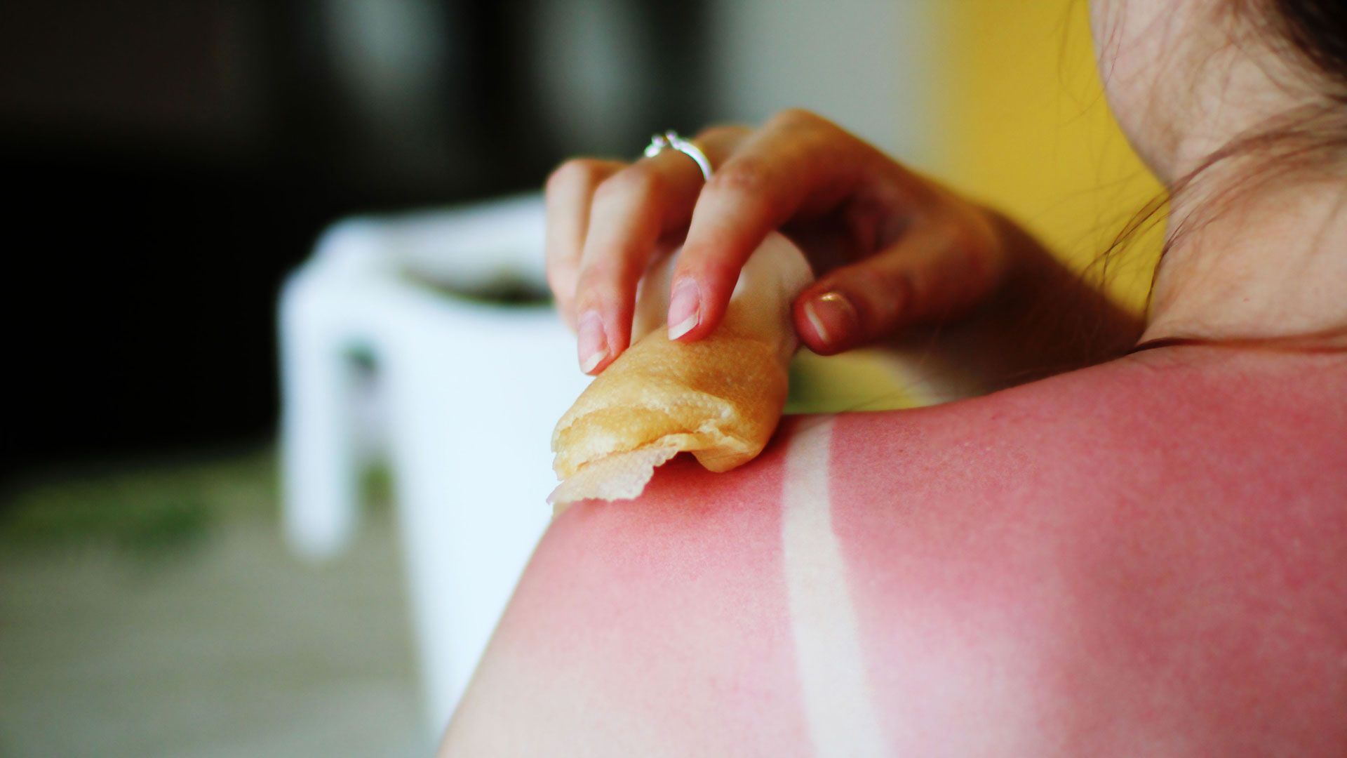 How do you take the itch out of a sunburn How To Get Rid Of Sunburn Sun Poisoning Relief Symptoms Blisters