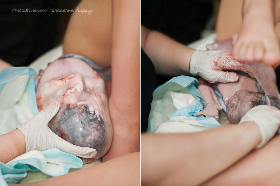Finger, Skin, Childbirth, Birth, Nail, Medical procedure, Baby, Patient, Flesh, Medical, 