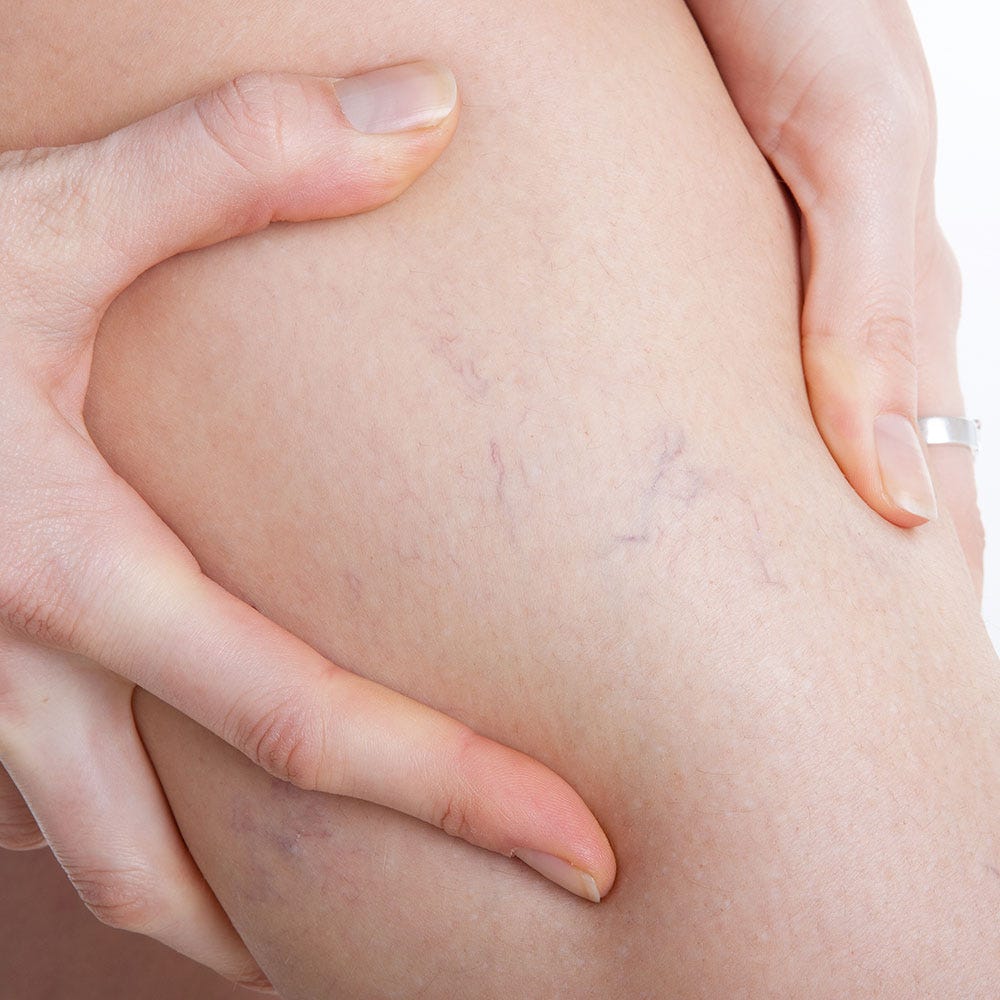 Everything you need to know about thread veins - Symptoms, causes, cure ...