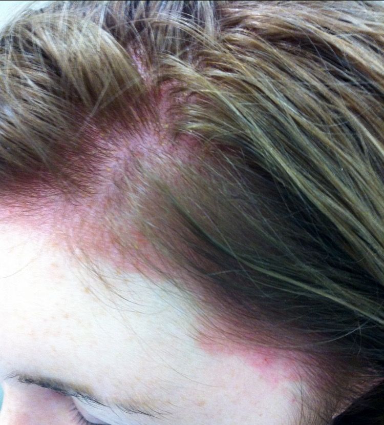Woman Has Horrible Allergic Reaction to Salon Hair Dye Job - PPD Allergy  Photos