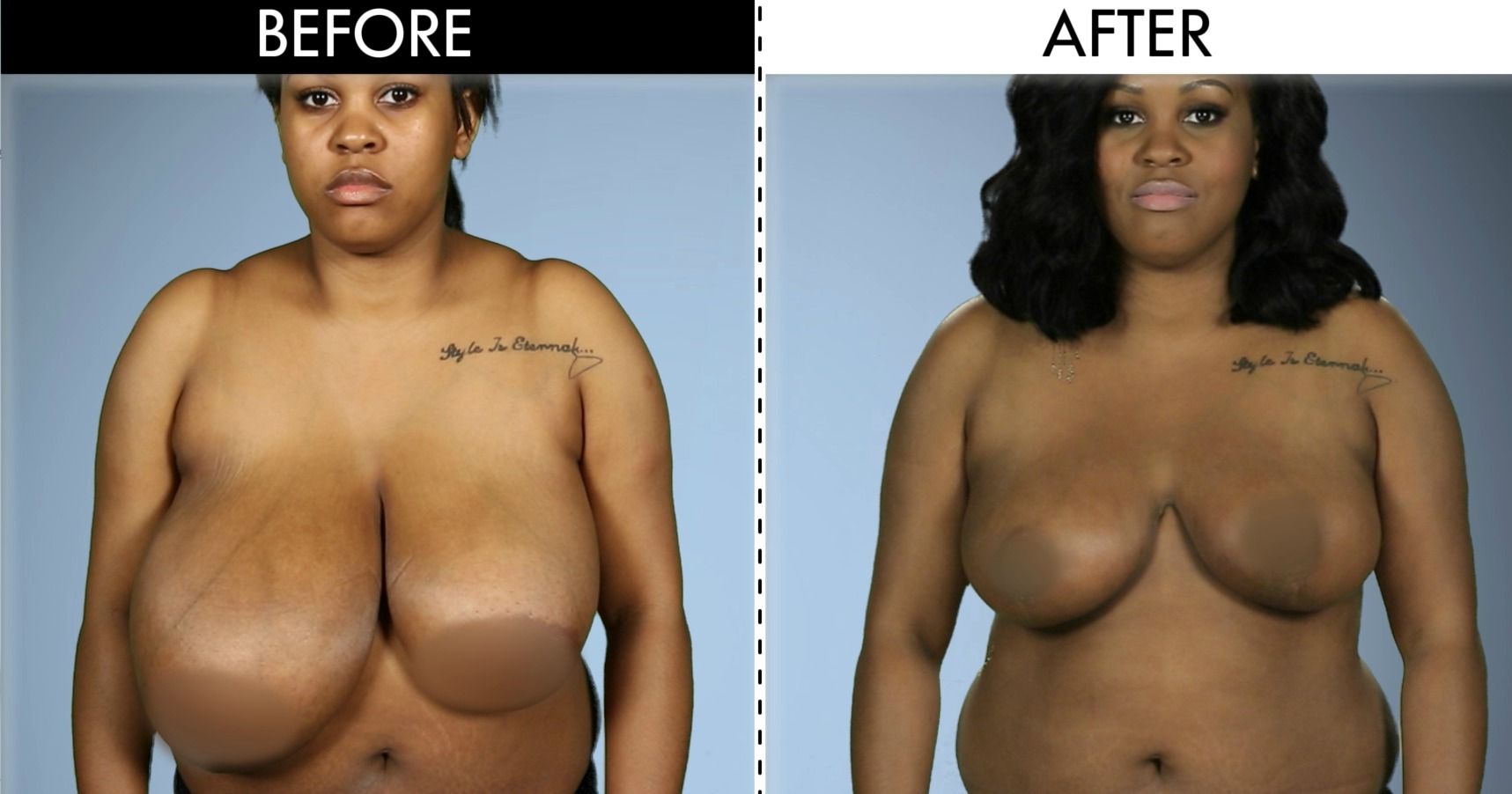 Can I Fix Uneven Breasts Without Implants? + 5 More Questions About Breast  Enhancement Surgery - Boston Plastic Surgery