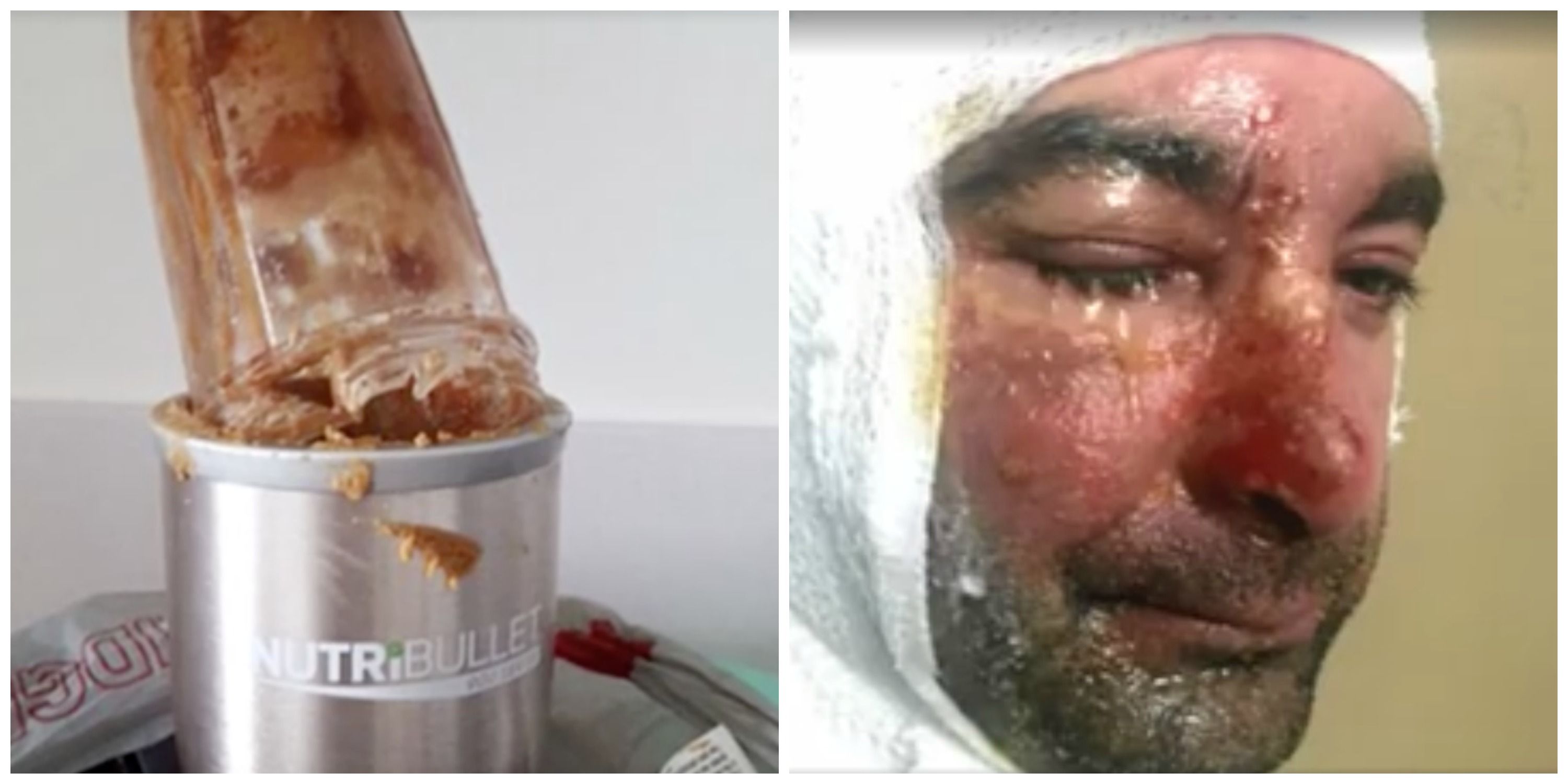 NutriBullet Blender Exploisions Reported Burn Injuries From Explosions