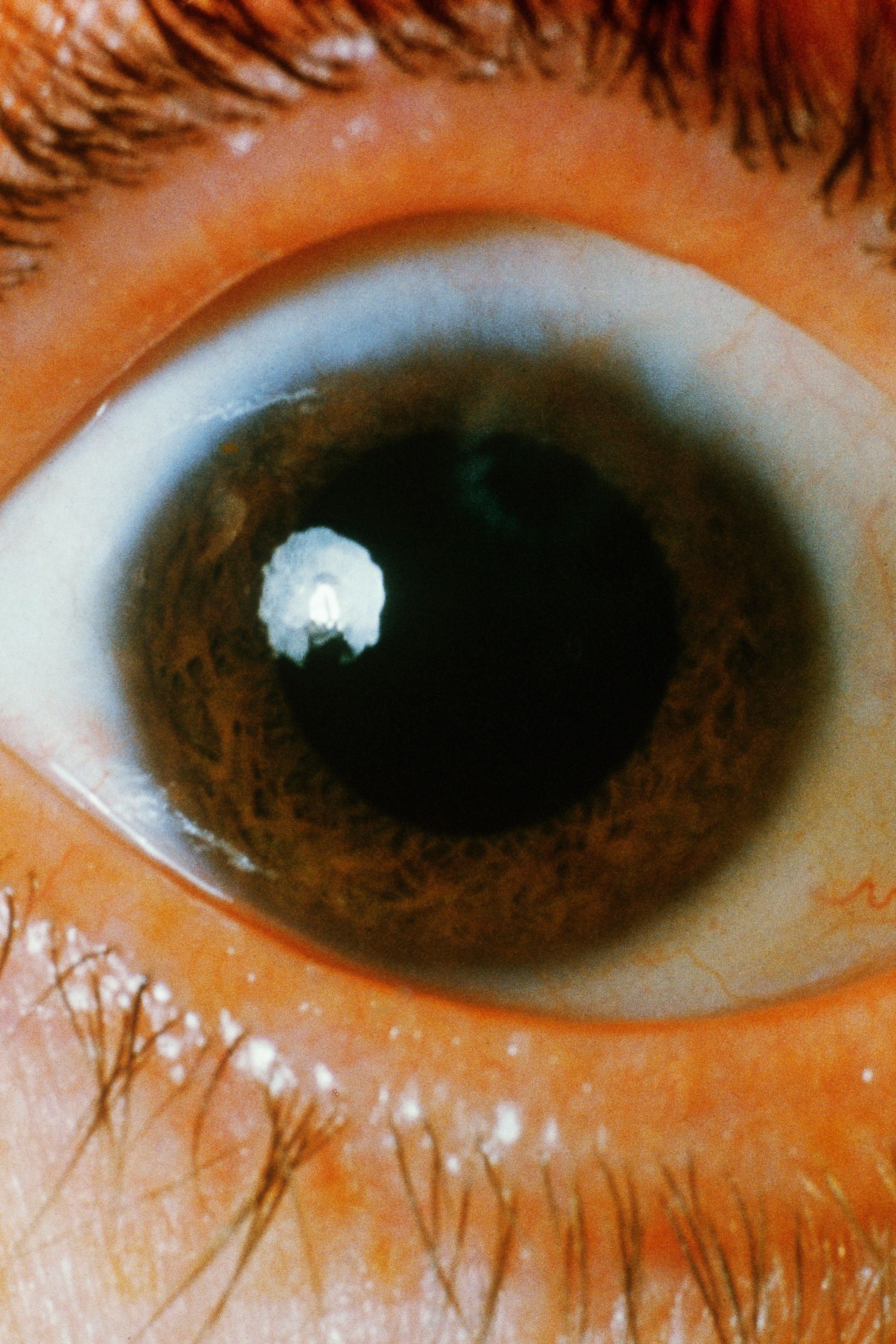 7 health problems predicted with a look into your eyes