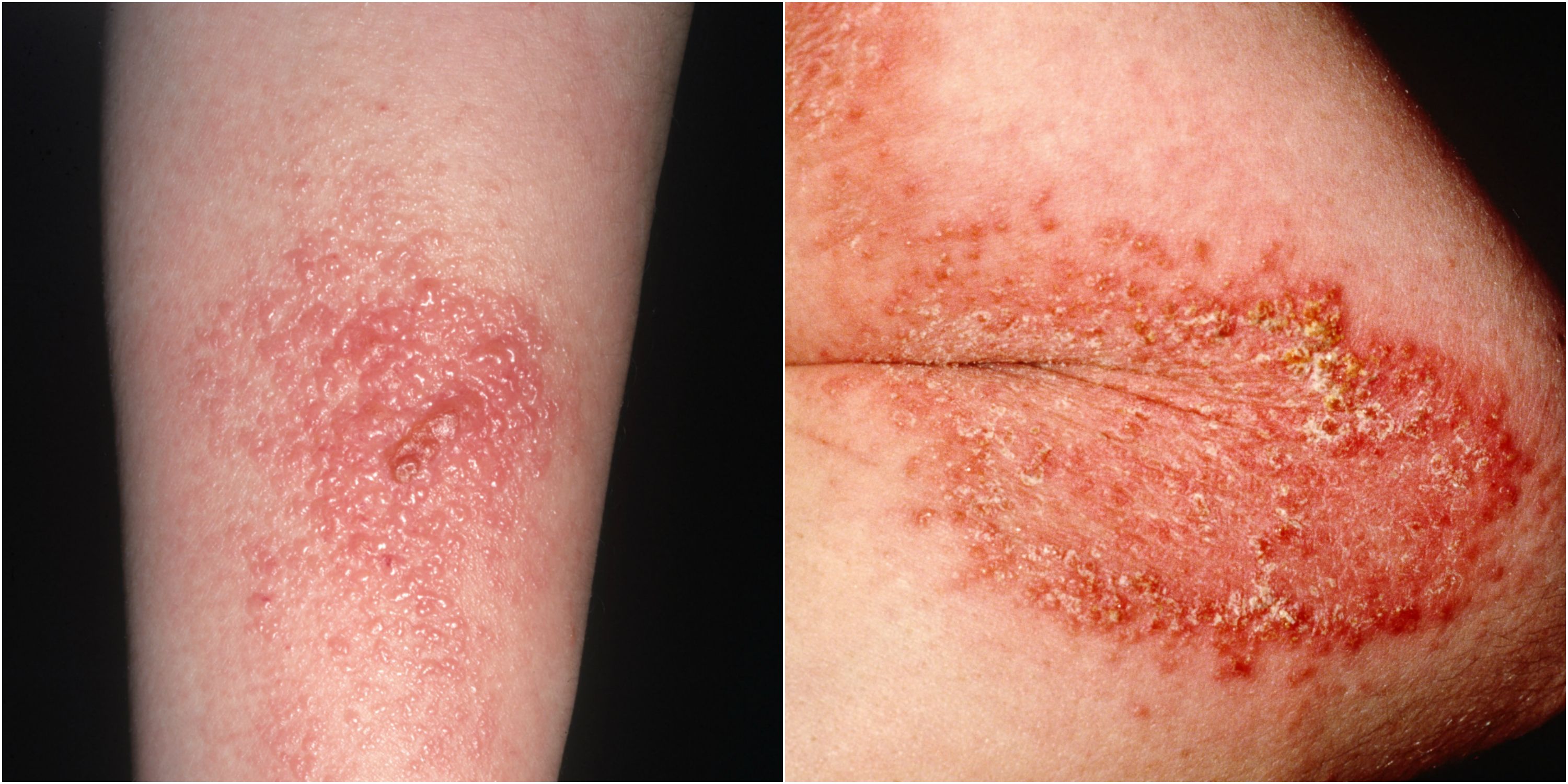 Posion Ivy Treatment - 128in61
