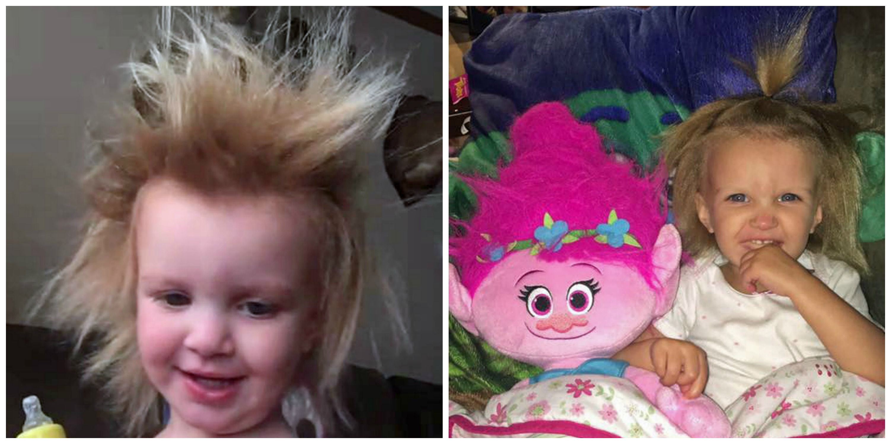 This Little Girl Has a Rare Disorder Called Uncombable Hair Syndrome - Uncombable  Hair Syndrome