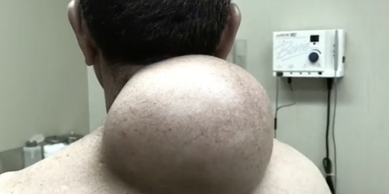 Hovedløse analog tit Dr. Pimple Popper Hurricane Harvey Relief - Watching Pimple Popping Video  Helps Hurricane Harvey Relief