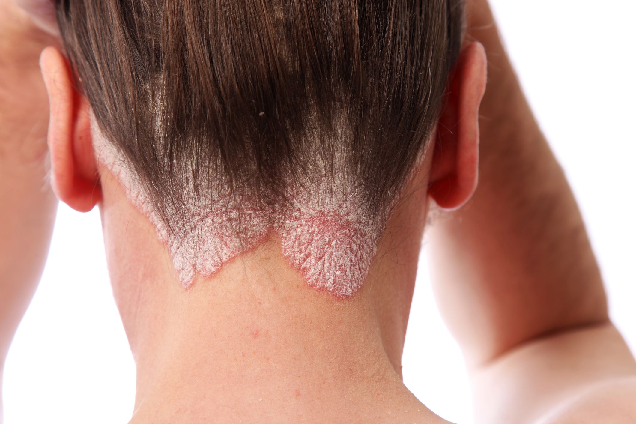 scaly scalp spots