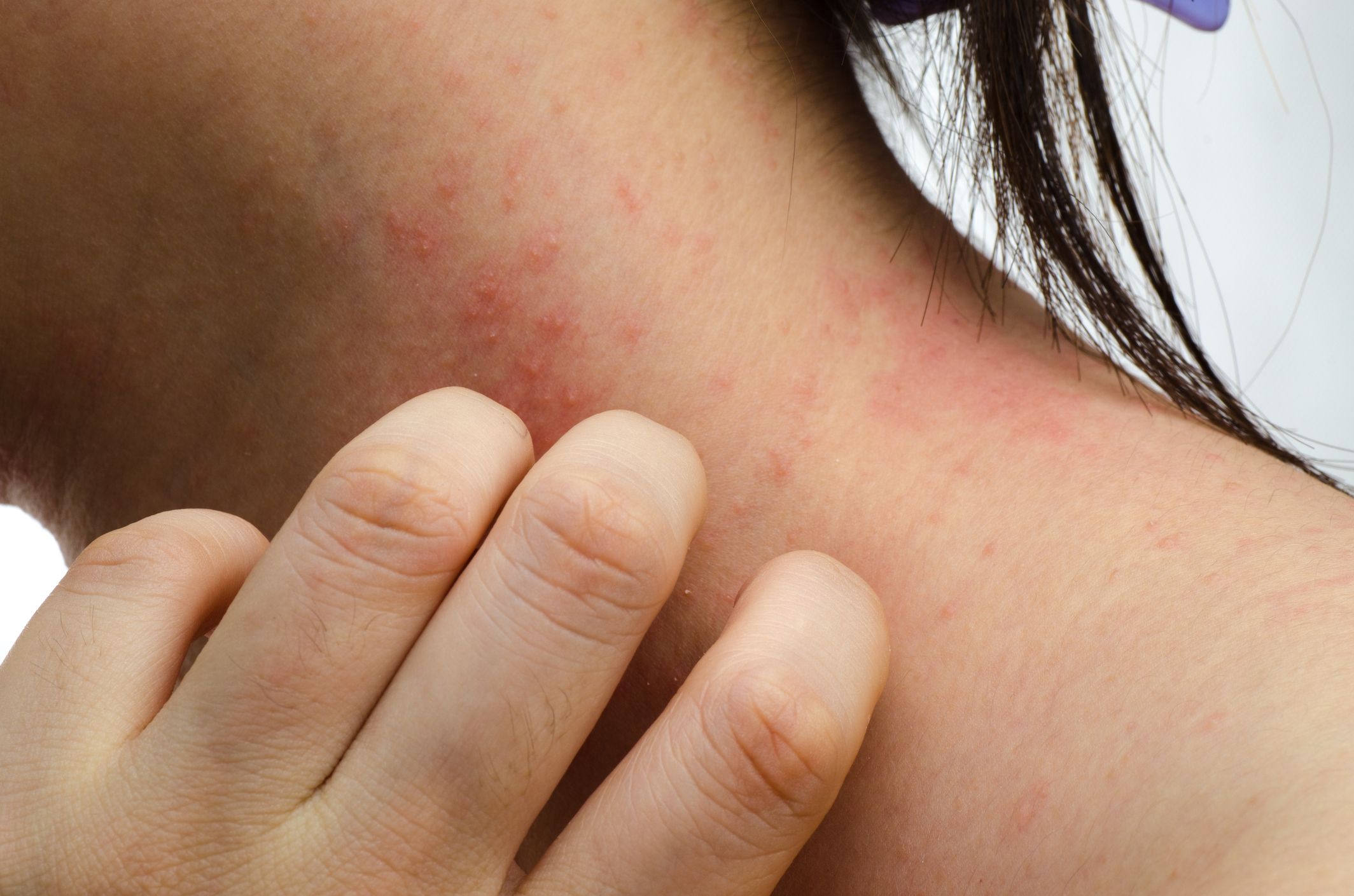 bumpy rash on neck