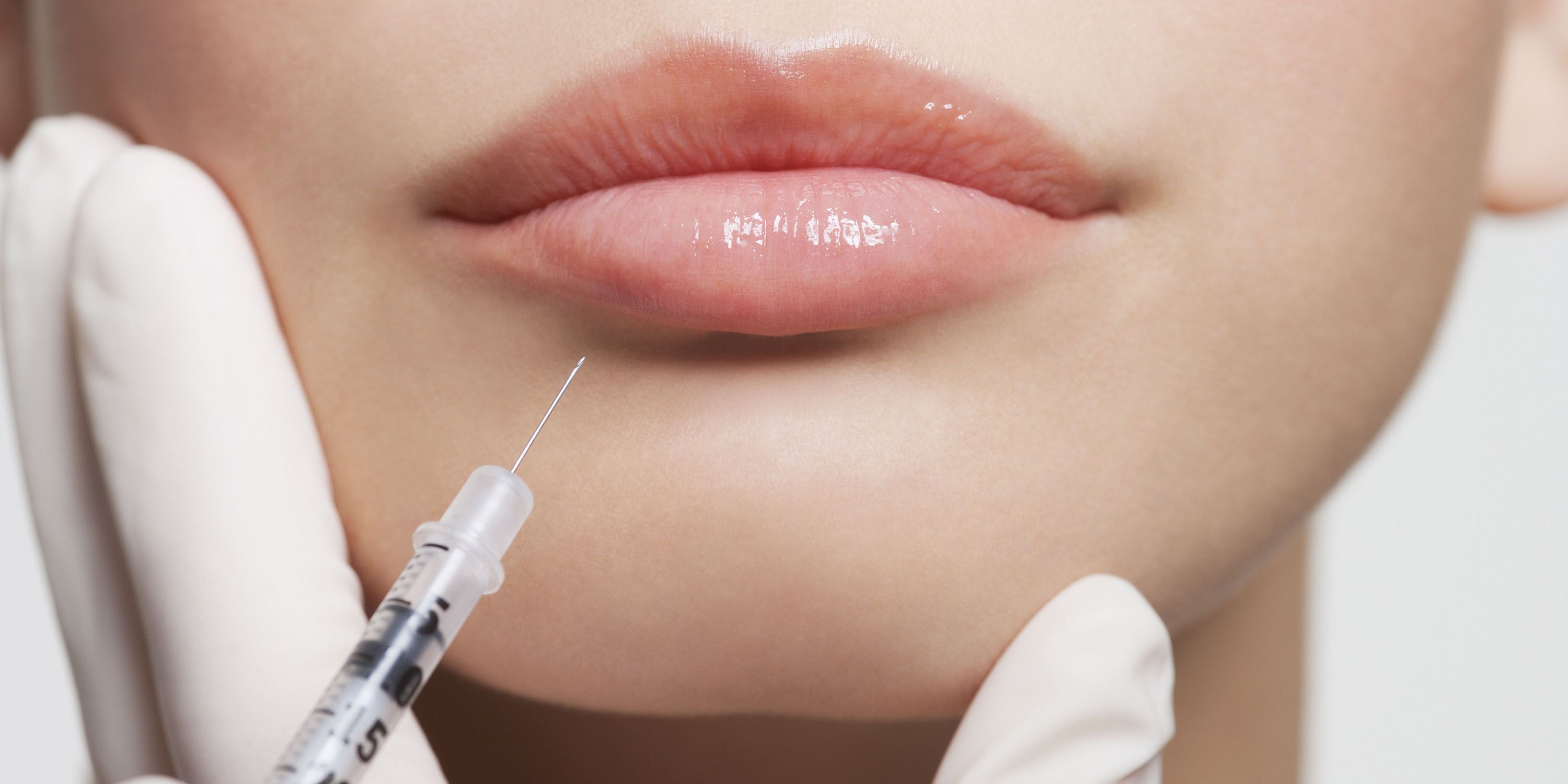 How to Get Rid of Lines Around Mouth, Smile Line Injections